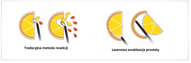 grafika resekcji